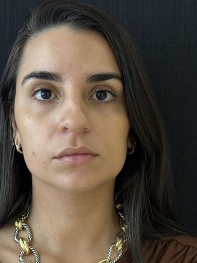 Depois — Bioestimulador de colágeno: Contorno e firmeza