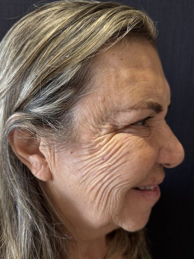 Antes — Protocolo de rejuvenescimento: Bochechas e sustentação