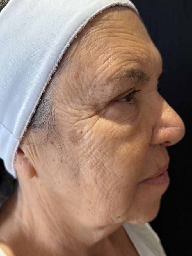 Depois — Protocolo de rejuvenescimento: Bochechas e sustentação