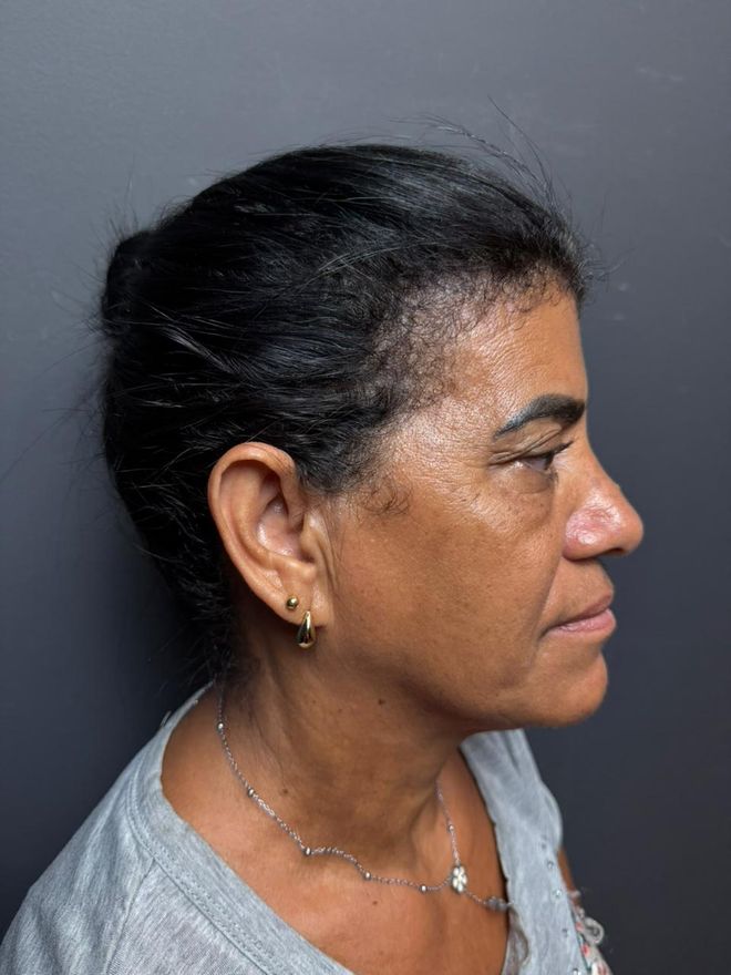 Depois — Ultraformer: Papada em perfil
